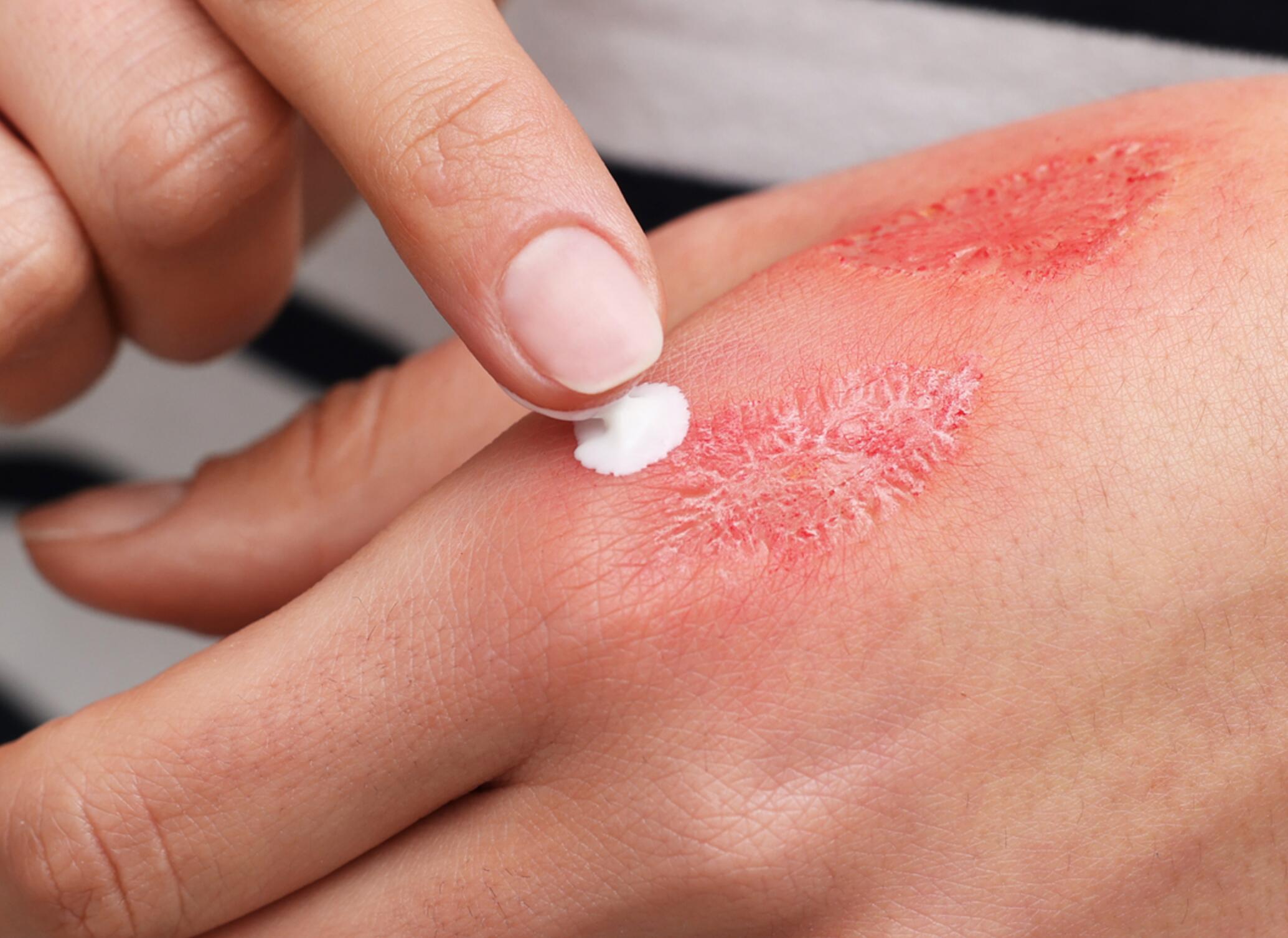 brandwond aan de hand crème aanbrengen